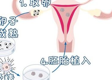 哪些因素会导致试管婴儿胚胎移植取消？